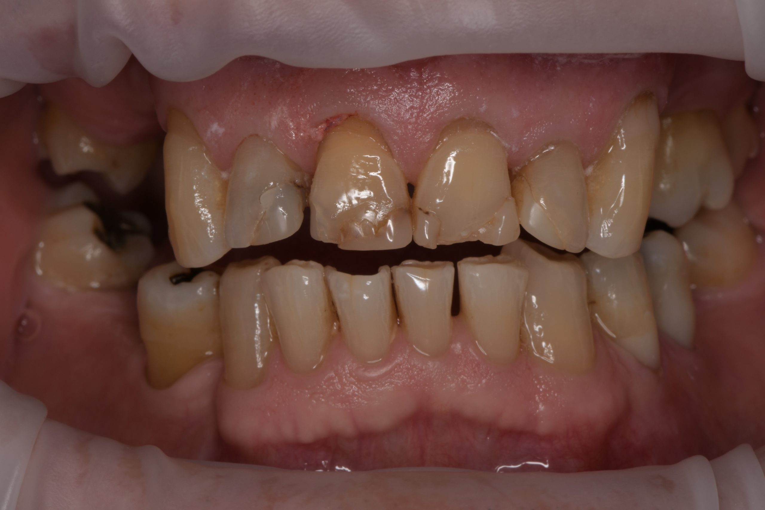 Broken teeth and large fillings on upper front teeth