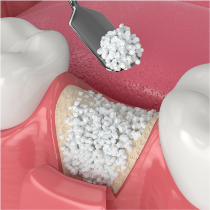 3D illustration of bone grafting material being placed into the jawbone near molars.