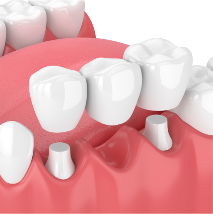 3D illustration of a dental bridge being placed over prepared teeth to replace a missing tooth.