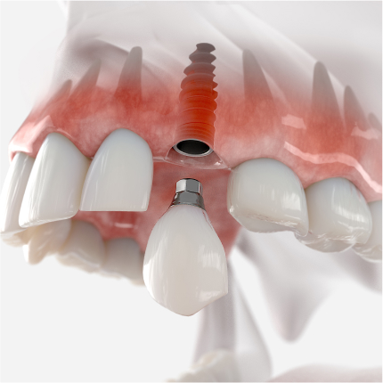 3D illustration of a fixed dental implant being placed into the upper jaw to replace a missing tooth.