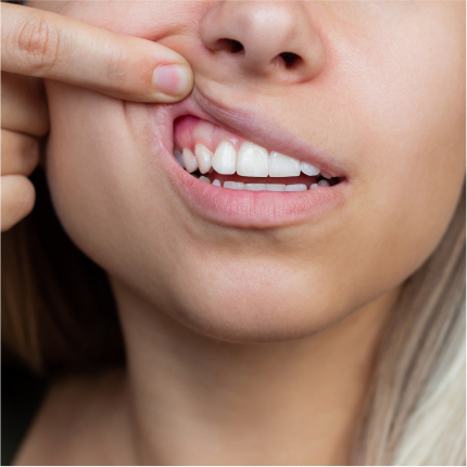 Close-up of woman lifting upper lip to show gums and teeth, highlighting periodontal health.