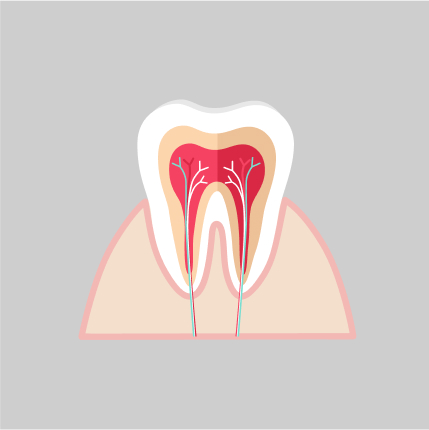 Illustration of a tooth cross-section showing nerves and pulp, representing root canal therapy.
