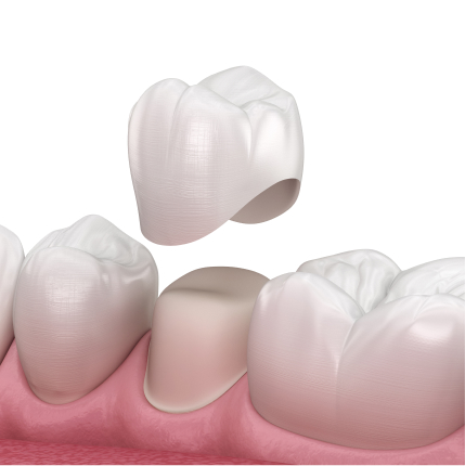 3D illustration of a same-day dental crown being placed over a prepared tooth.
