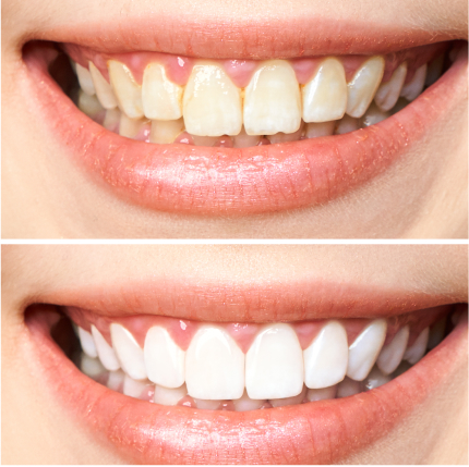 a woman's teeth before and after whitening