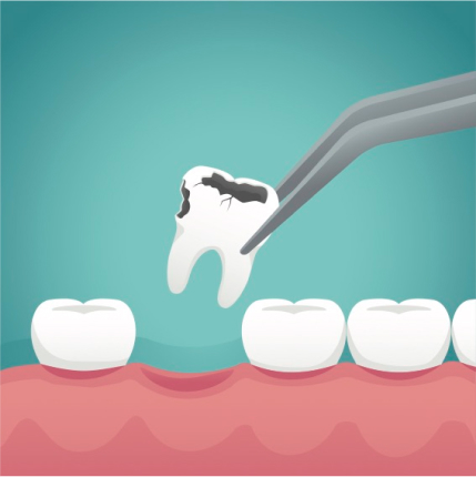 Illustration of a decayed tooth being extracted with dental forceps from a row of healthy teeth.