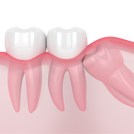 3D illustration of an impacted wisdom tooth pushing against neighboring molars beneath the gumline.