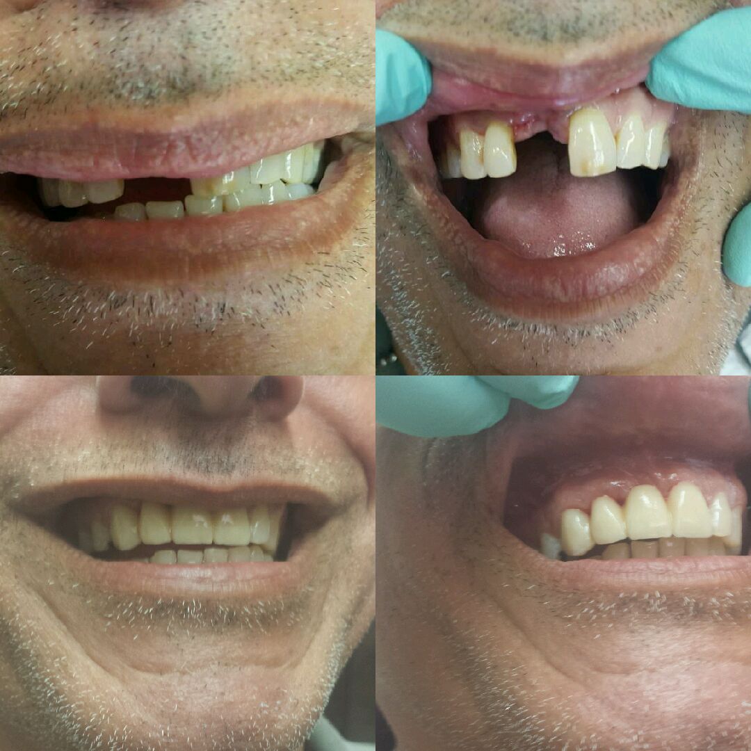 Before and after same day CEREC bridge for failed front tooth implant