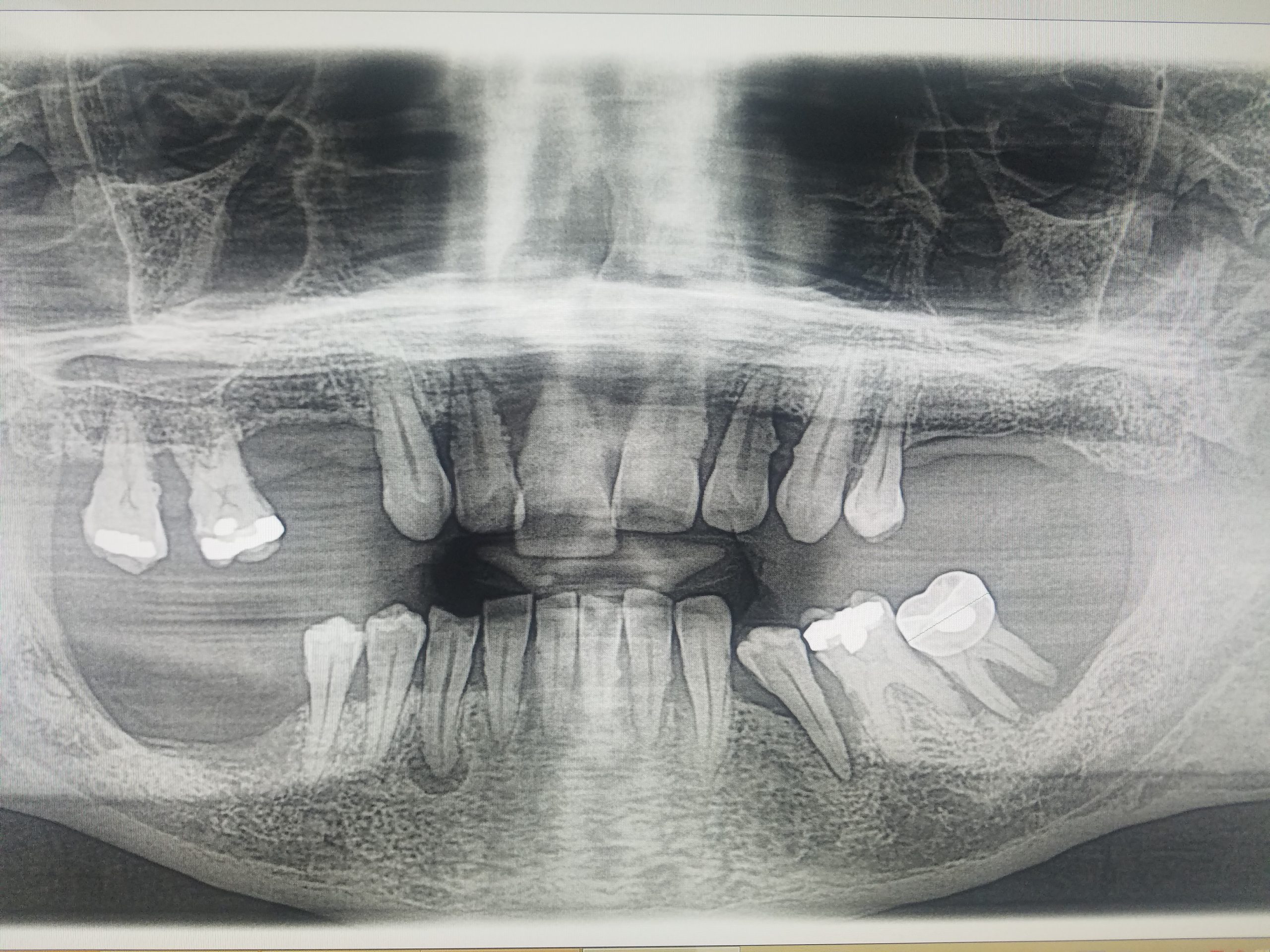 Dental x-ray showing full arch implants placed after tooth removal