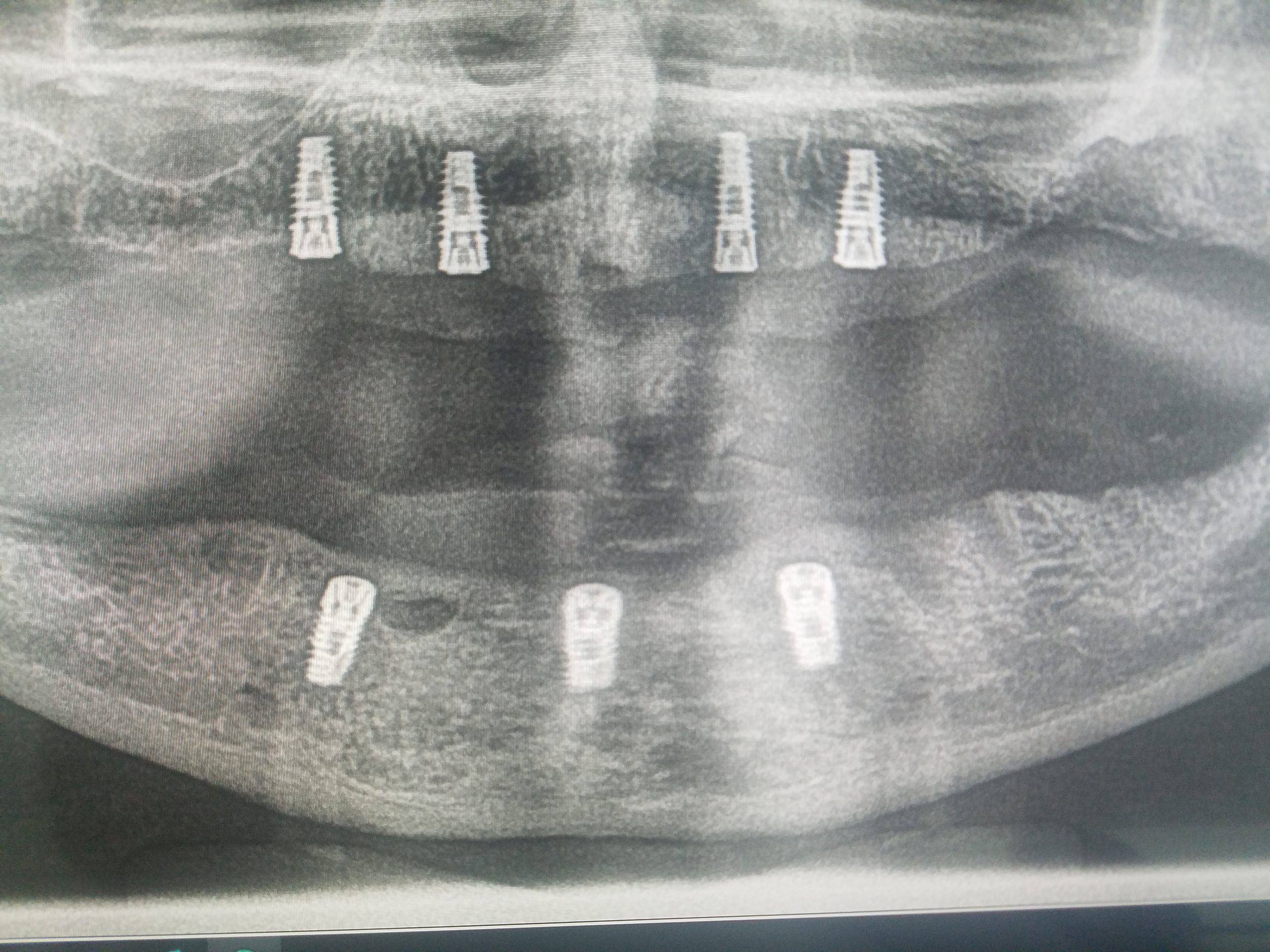 Dental x-ray showing severe periodontitis and tooth loss risk