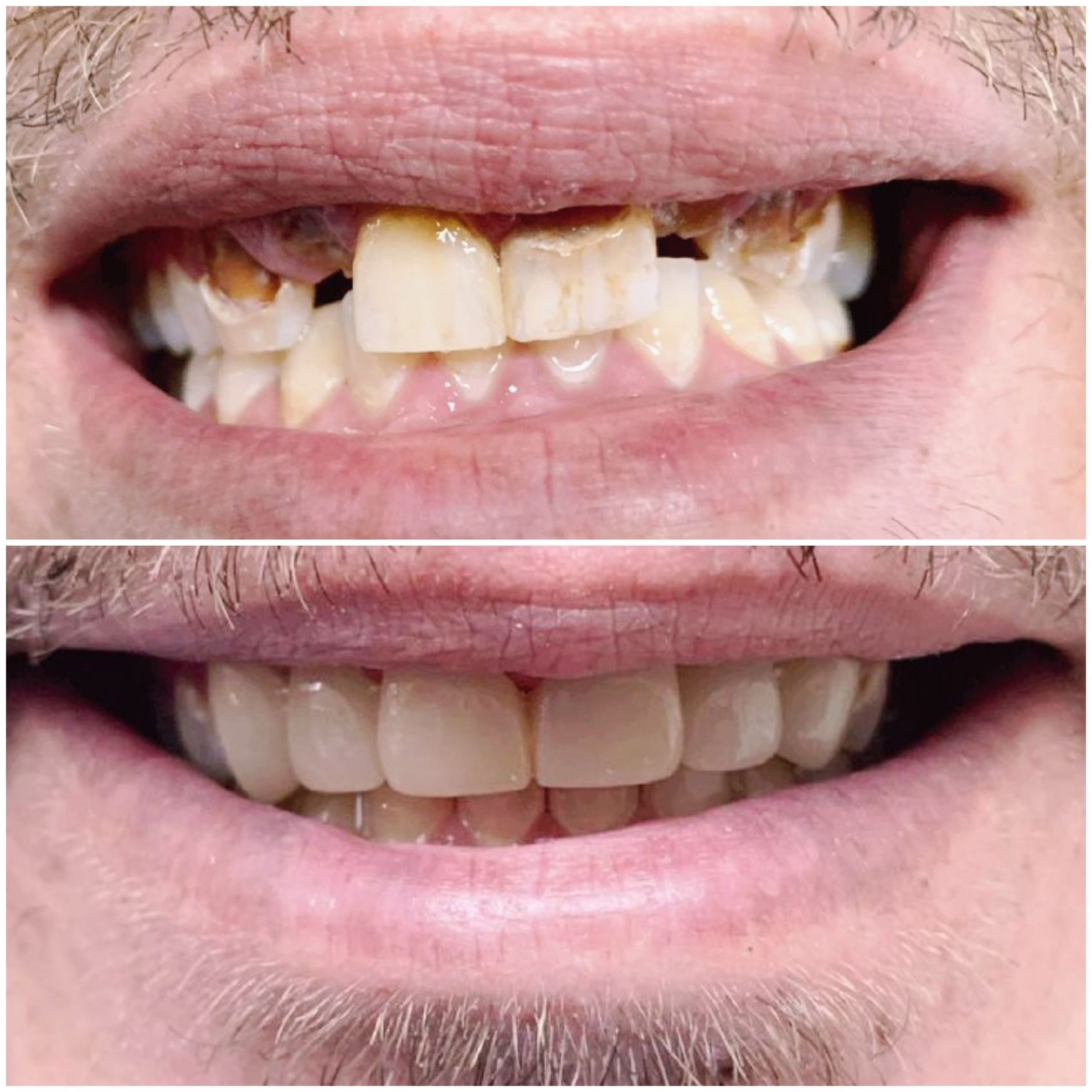 Smile makeover before and after severe front tooth cavities with dental bridges