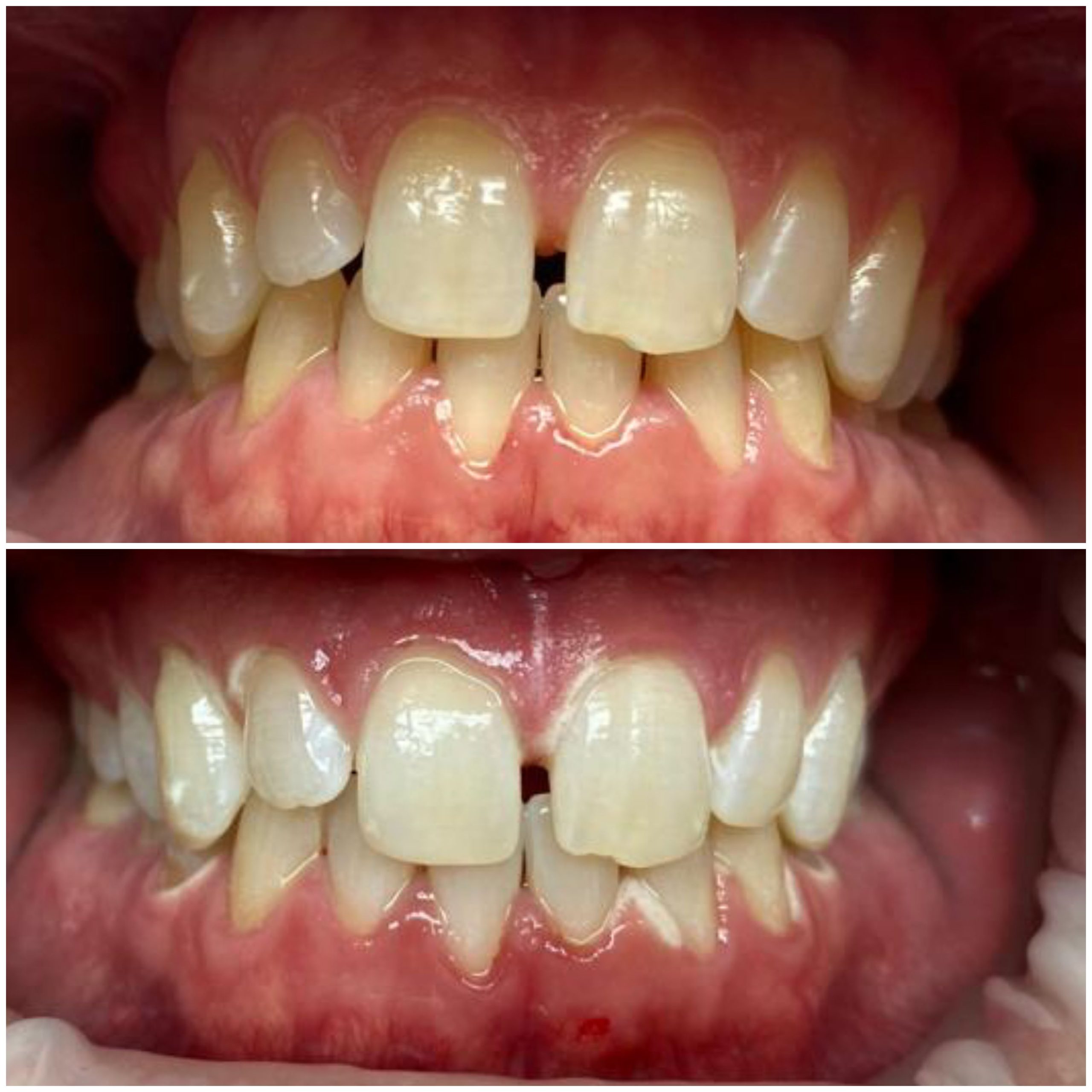 Before and after same-day ZOOM whitening showing brighter teeth