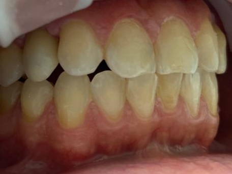 Orthodontic result with canines moved into lateral incisor positions