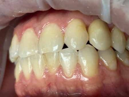 Dental implants placed to replace missing lateral incisors in canine area