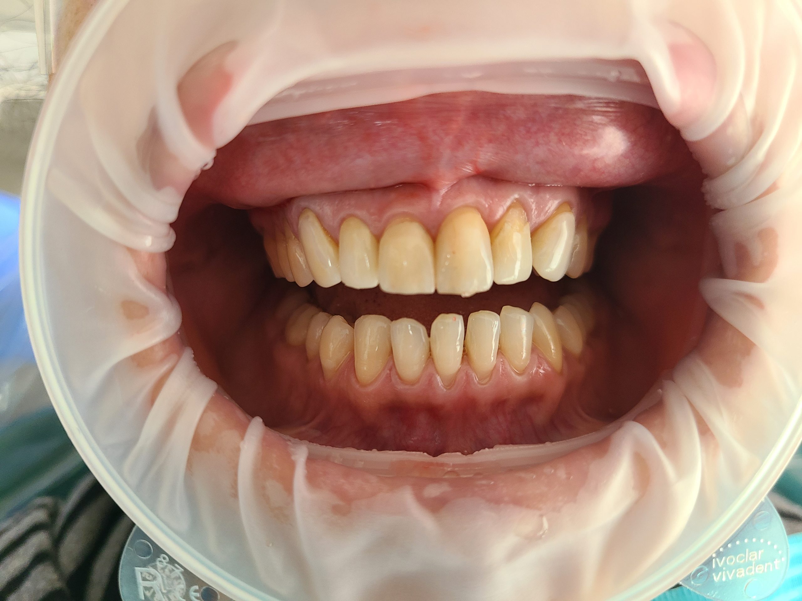 Upper front veneer chipped and discolored before CEREC replacement