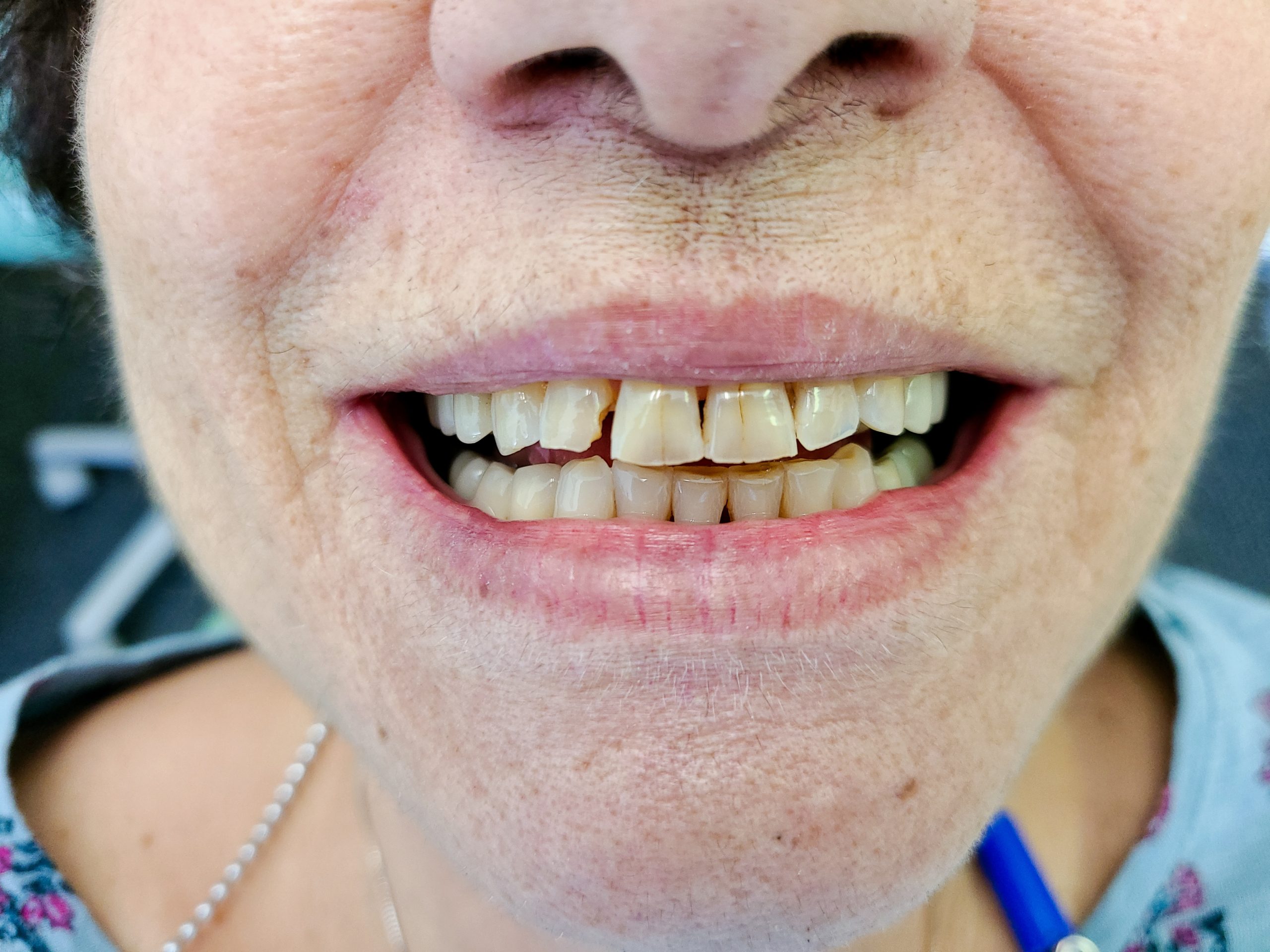 Broken, decayed front teeth with severe discoloration