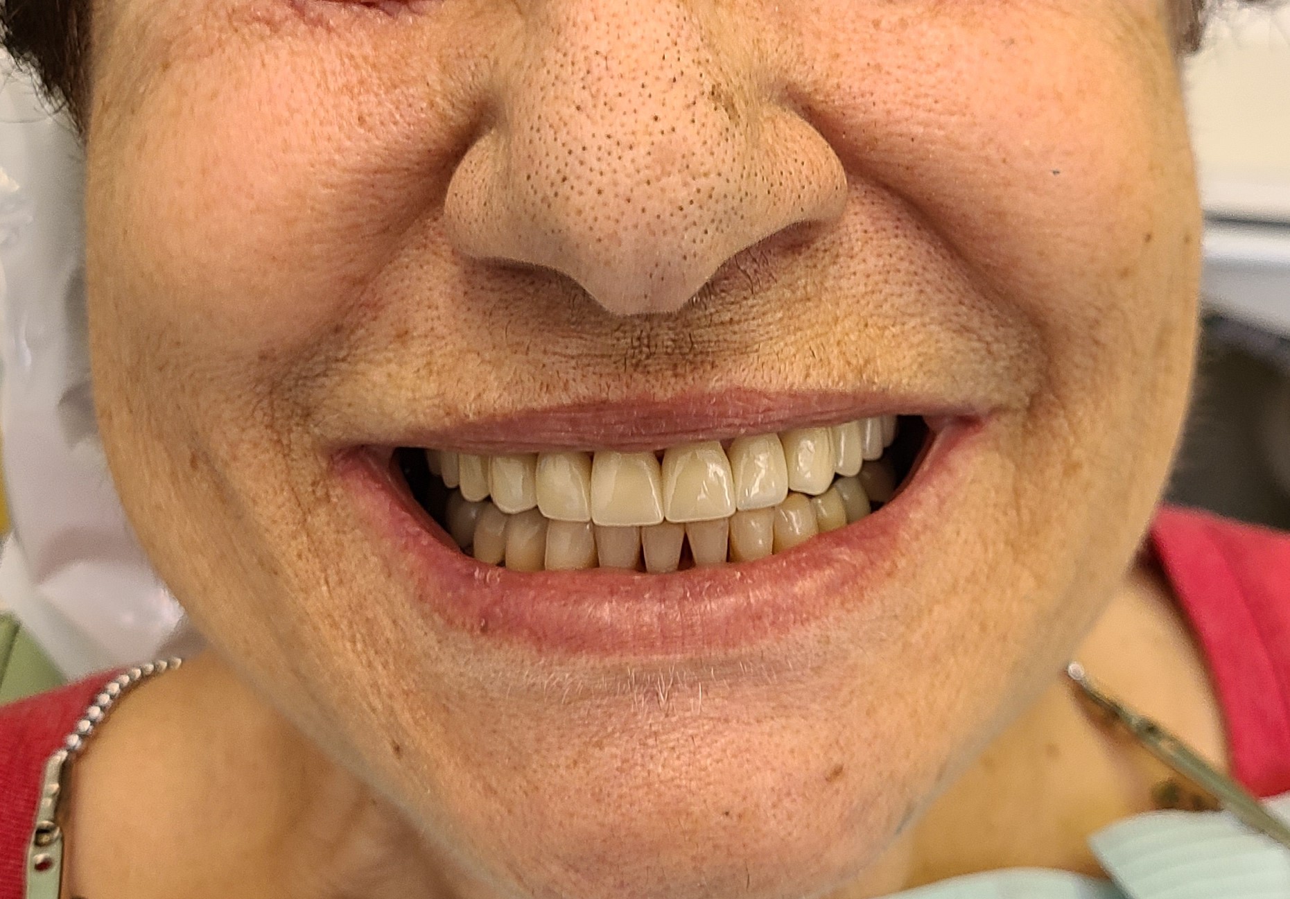 Repaired smile with dental crowns and veneers on upper teeth