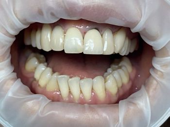 Upper front tooth with failed root canal before extraction and implant