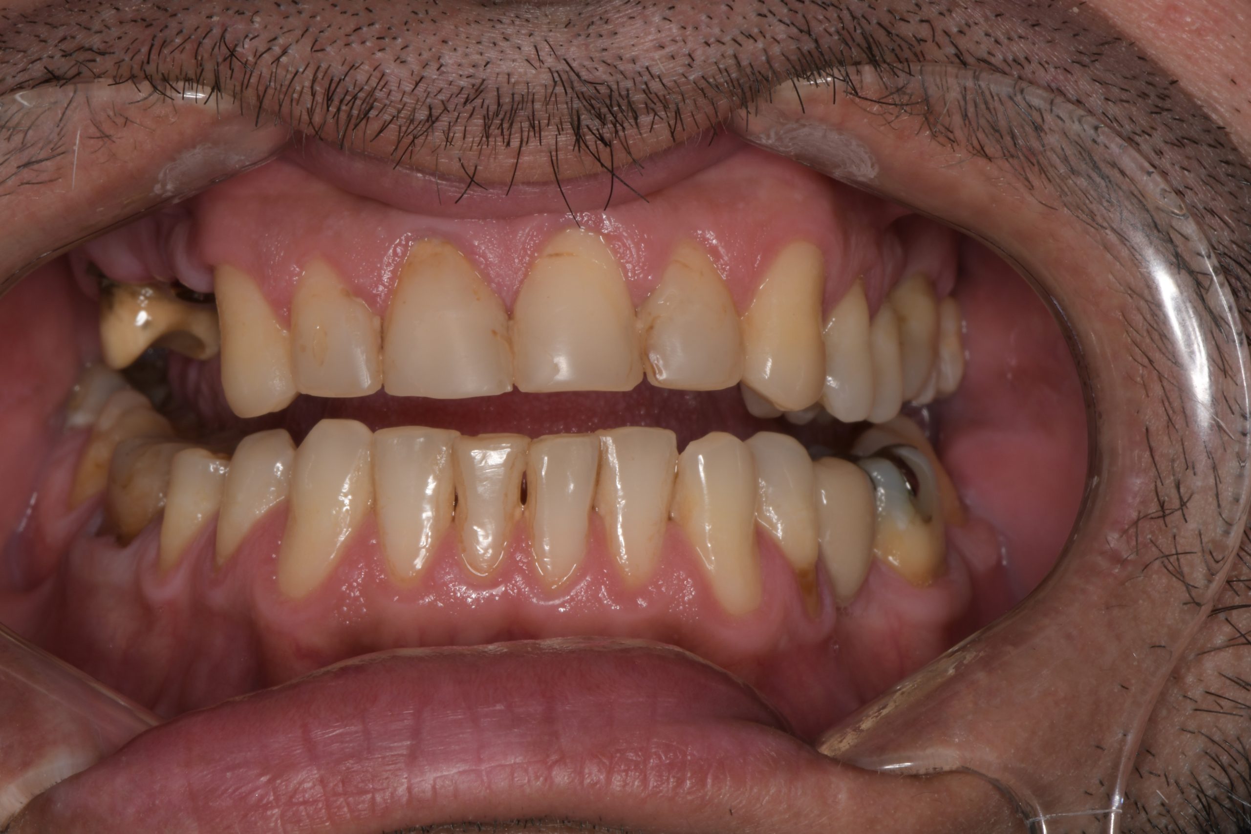 Multiple broken and decayed front teeth with old dental restorations