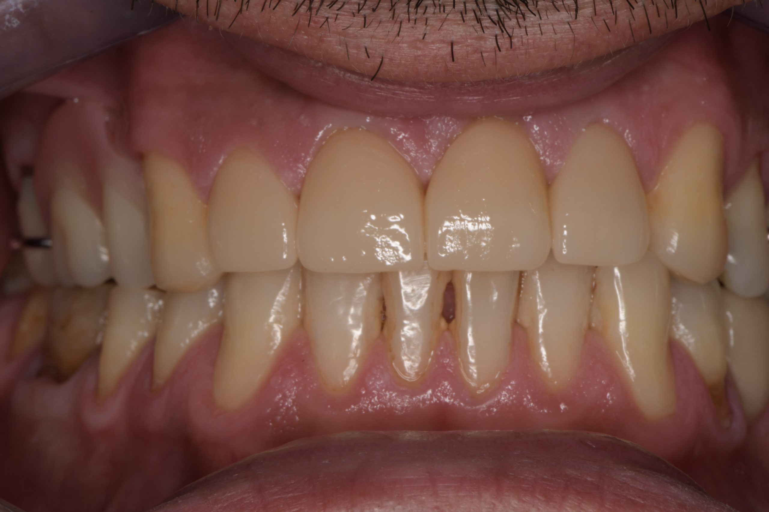 Repaired front teeth using CEREC E.MAX crowns for a natural-looking smile