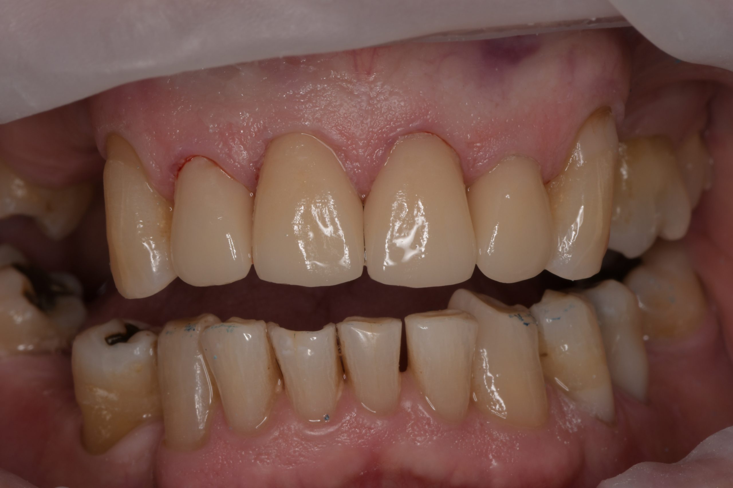 Repaired front teeth using same-day CEREC crowns