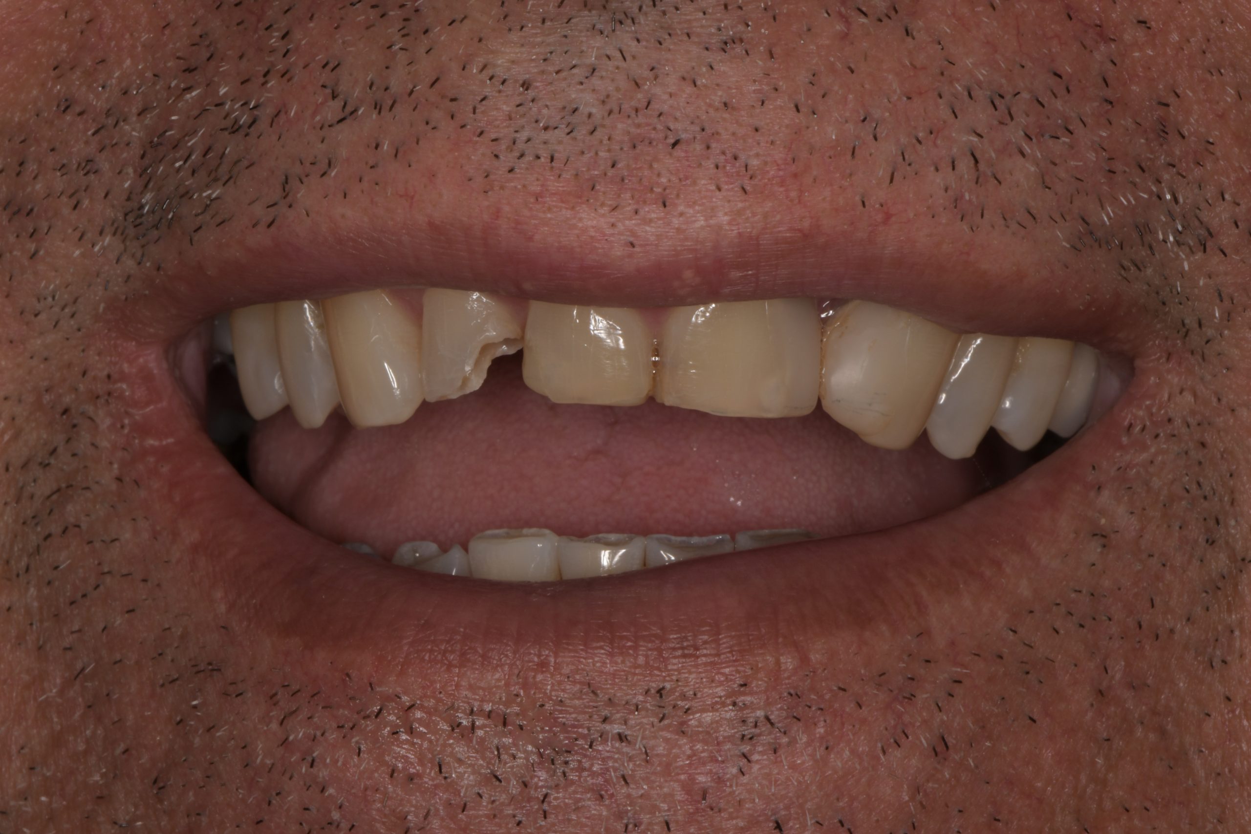 Fractured front teeth with spacing issues before CEREC same day crowns