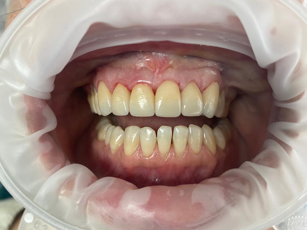 Upper front tooth restored with same day CEREC veneer replacement
