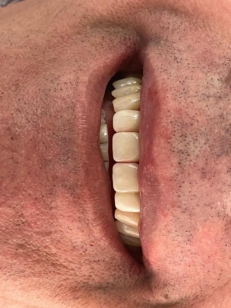 Restored front teeth with even spacing after CEREC same day crown treatment