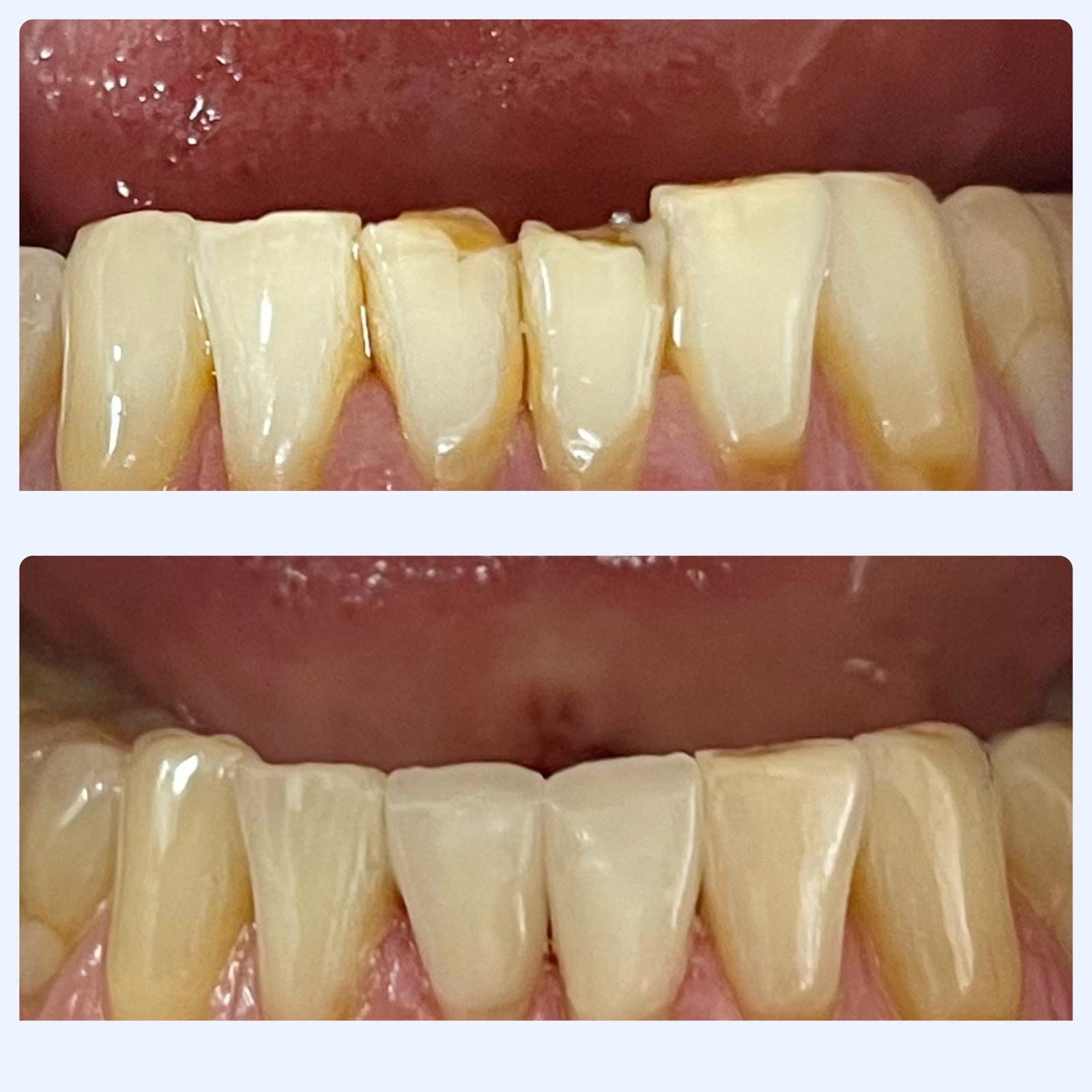Lower front teeth before and after same day CEREC veneer restoration