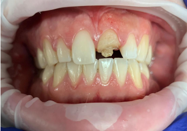 Damaged front tooth before single crown restoration with CEREC