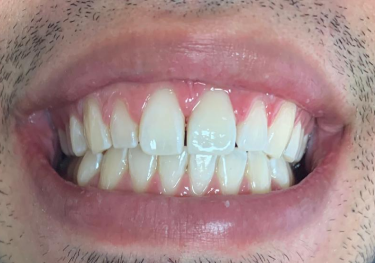 Smile after front tooth restored with CEREC single crown