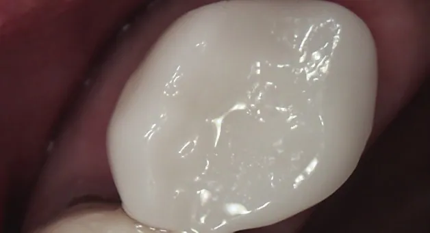 Close-up of a restored molar with a smooth, white CEREC crown after treatment.