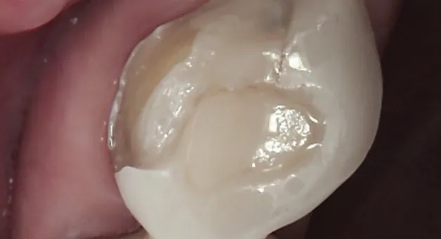 Close-up of a damaged molar with decay before CEREC crown restoration.
