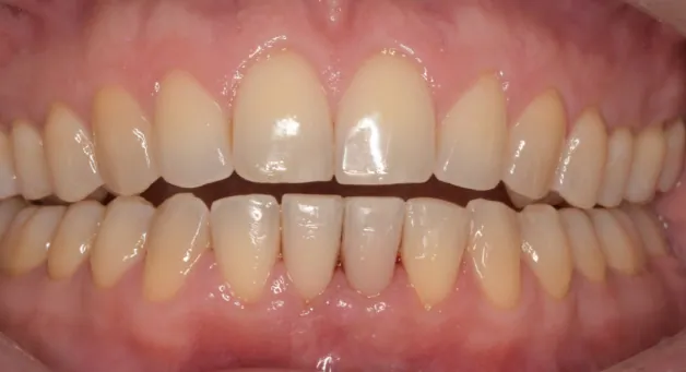 Healed gums and aligned teeth after emergency dental care.