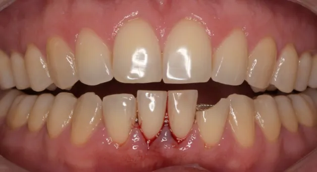 Teeth with bleeding gums and injury before emergency dental treatment.
