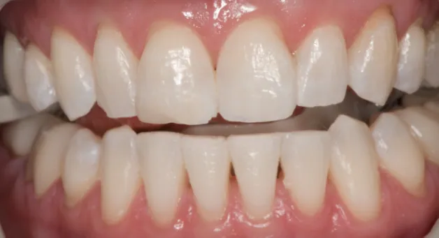 Brighter, whiter teeth after Zoom whitening treatment.