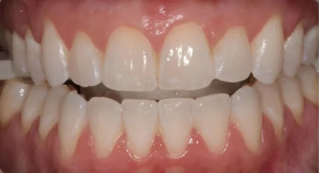 Teeth after Zoom whitening, noticeably brighter with a whiter shade.