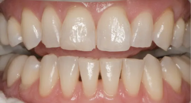 Teeth with mild yellowing before Zoom whitening treatment.
