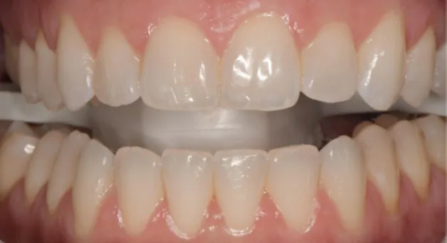 Teeth before Zoom whitening, slightly dull in color with mild staining.
