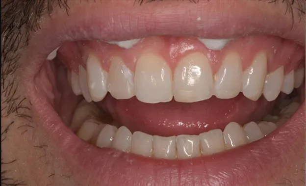 After Clear Aligner Treatment