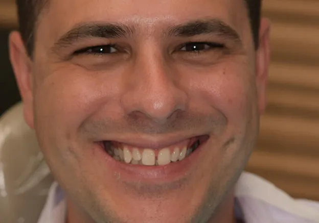 Before Clear Aligner Treatment