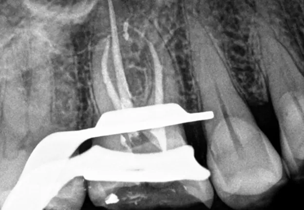 Tooth After Root Canal Therapy