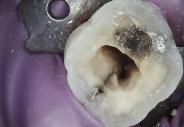Tooth Before Root Canal Therapy