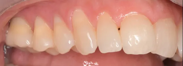 Tooth After Dental Crown