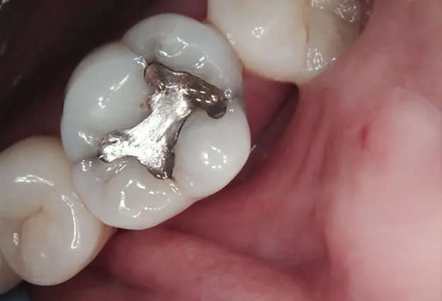 Tooth Before Dental Crown