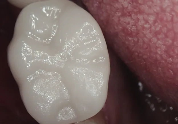 Tooth After Dental Crown