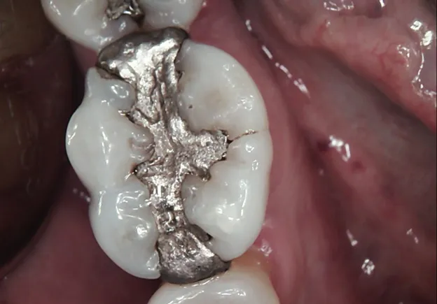 Tooth Before Dental Crown