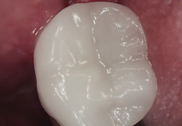Tooth After Dental Crown