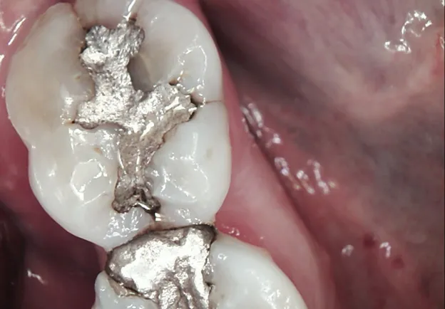 Tooth Before Dental Crown